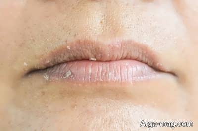 ترکیده شدن پوست لب