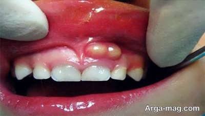 علل ایجاد عفونت دندان