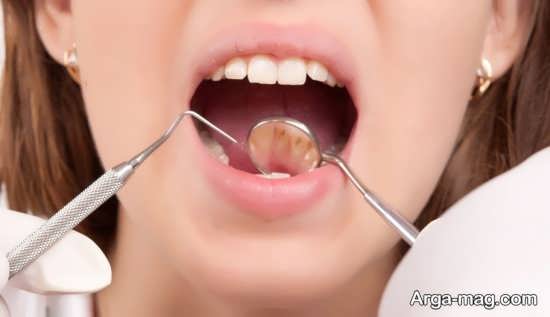 راه های مراقبت بعد از کشیدن دندان