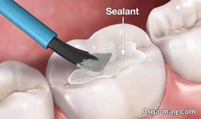 انواع روش برای پیشگیری از پوسیدگی دندان