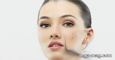 لایه برداری قوی ماسک چای ترش
