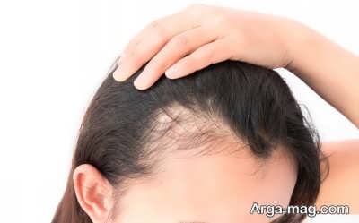 درمان ریزش مو با استفاده از پودر ثعلب