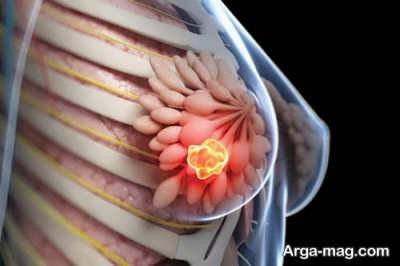 نشانه های هشدار دهنده سرطان پستان