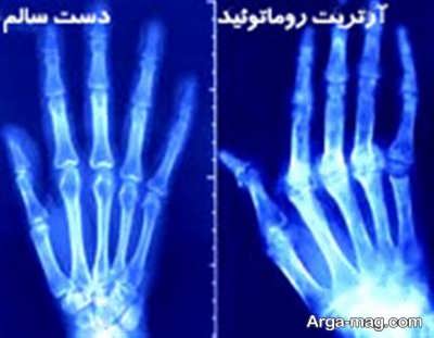علت و درمان آرتریت روماتوئید