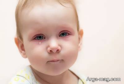 درصورتی که آبریزش چشم نوزاد درمان نشد باید به پزشک مراجعه کنید