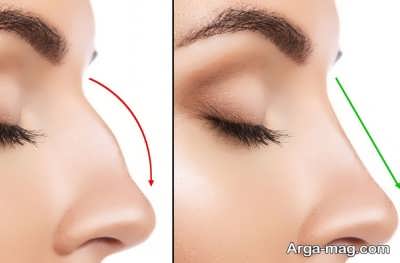 جراحی زیبایی برای بینی های استخوانی