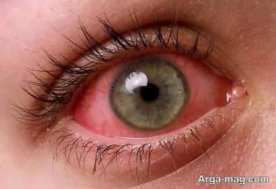  درمان کردن خانگی عفونت چشم