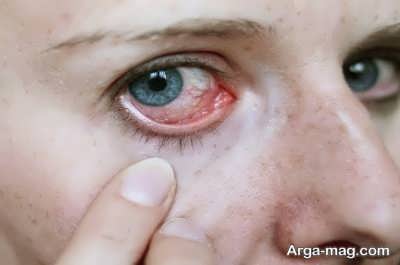  چاره و درمان خانگی عفونت چشم