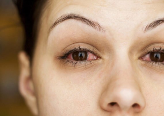 روش های درمان خانگی عفونت چشم