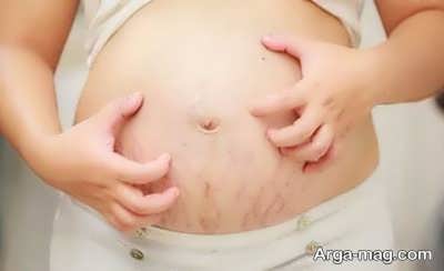 تغییرات پوستی در دوران حاملگی