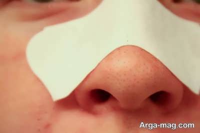 دستگاه مکنده و روش های تخلیه جوش سرسیاه
