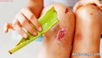 روش های درمان خانگی عفونت زخم