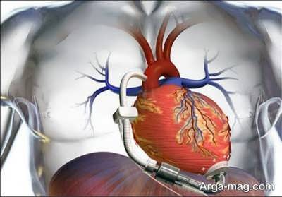 موثرترین روش ها در درمان نارسایی قلب