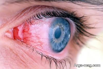 بررسی درمان برق زدگی چشم