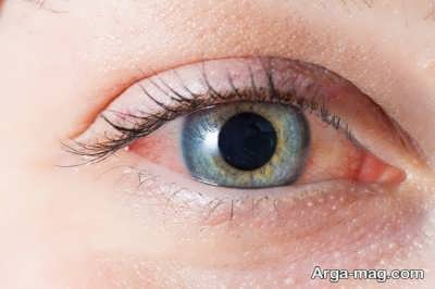روش درمان برق زدگی چشم