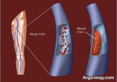 عوامل لخته شدن خون در پا