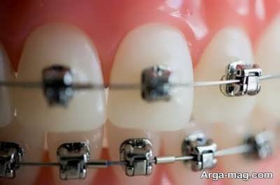 ارتودنسی بریس دندان