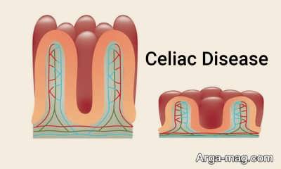 راه های تشخیص سلیاک