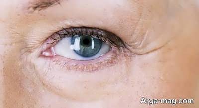 درمان خشکی دور چشم