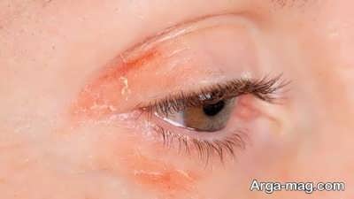 درمان خشک شدن پوست چشم