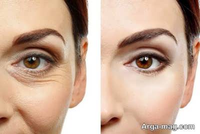 بهترین راه جلوگیری از پیری پوست چشم