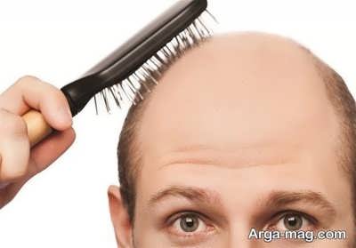 علت ریزش موی شدید چیست؟