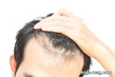 علت کم پشتی مو چیست؟