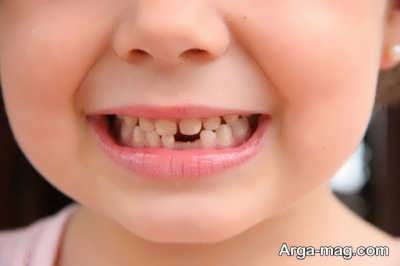 آشنایی با عوارض پوسیدگی دندان کودکان