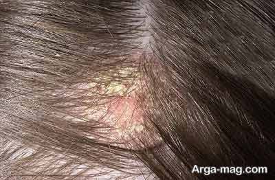 سرطان پوست یکی از دلایل ایجاد زخم در سر می باشد.