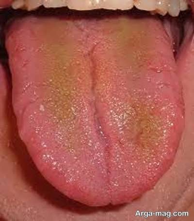 معرفی بیماری زردی زبان