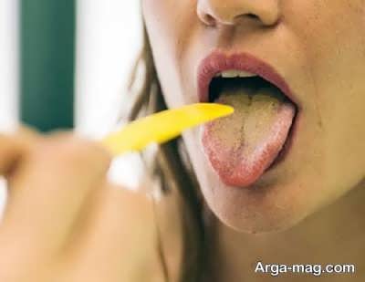 چه هنگام برای زردی زبان باید به پزشک مراجعه کنید