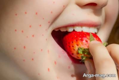 راه های درمان آلرژی میوه ای