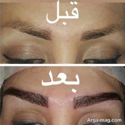 کاشت ابرو 