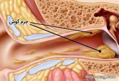 رفع جرم گوش به روش های مختلف
