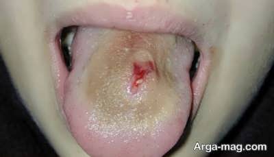 خطراتی که پیرسینگ زبان به وجود می آورد