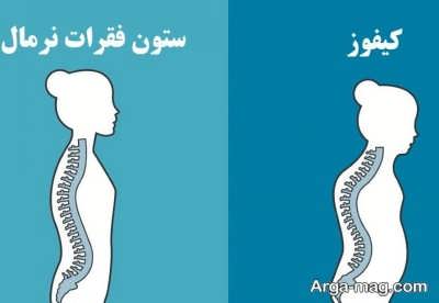 ورزش برای درمان قوز کمر