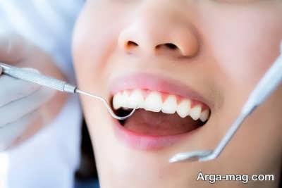 روش های رفع لکه دندان