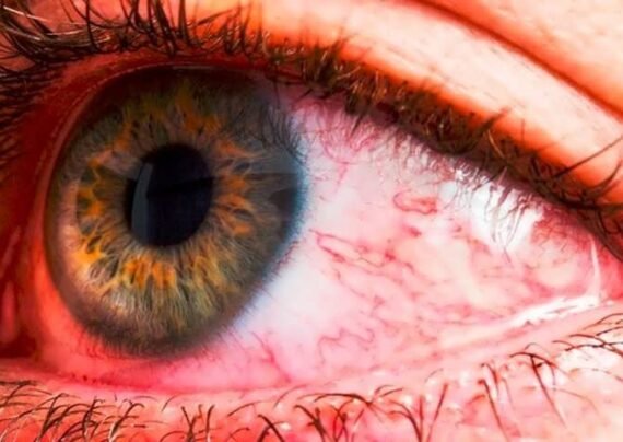 بررسی انواع التهاب چشم و نشانه های آن