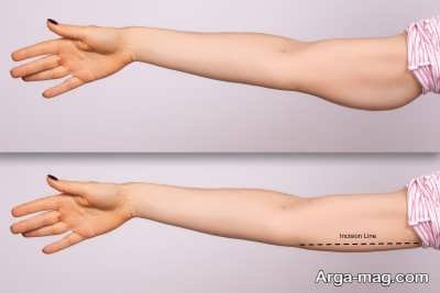 درمان و جراحی لیفت بازو