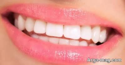 میناکاری دندان چونه انجام می شود؟