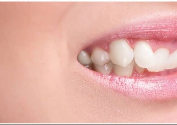 کراودینگ دندان و روش های درمان آن