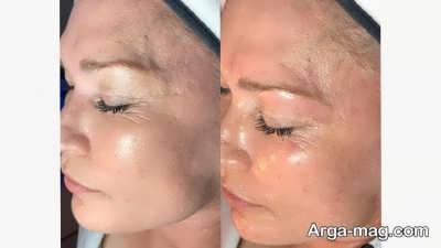 چگونگی جوان سازی پوست صورت