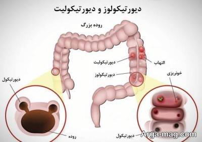 درمان دیورتیکولیت