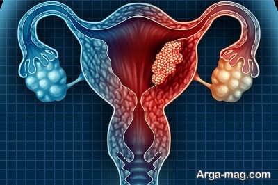 Cleansing the uterus 7 - پاکسازی رحم از عفونت و تقویت رحم با درمان های خانگی موثر