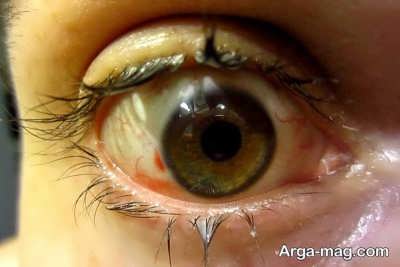 عفونت و ترشح چشمی
