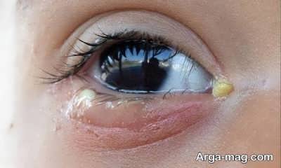 علت انواع ترشحات چشم