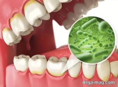 جلوگیری از عفونت بعد از کشیدن دندان