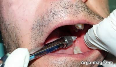 دلیل عفونت دندان چیست؟