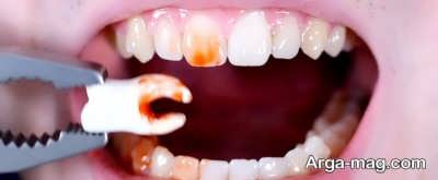 مراقبت های عفونت بعد از کشیدن دندان