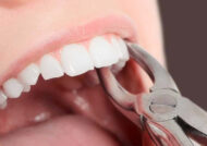 علائم عفونت بعد از کشیدن دندان